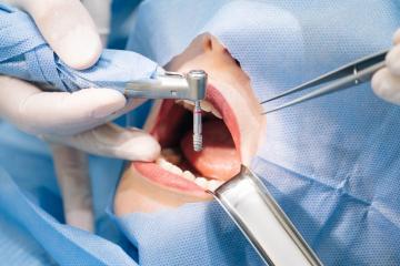 chirurg stomatolog, implant dentar chirurgie Bucuresti 