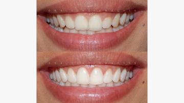 Gingivectomie