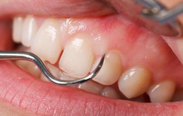 Gingivoplastie