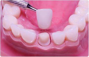 Coroane dentare