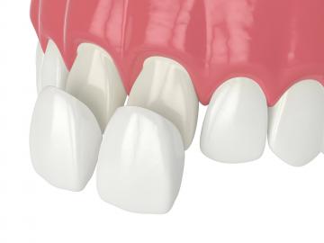 Fatete dentare