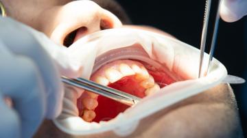 Chirurgie dentara