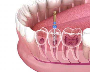 tratament de canal, tratament endodontic preturi, cabinet endodontic Bucuresti
