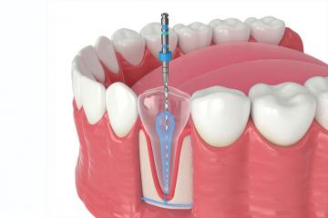 tratament de canal, tratament endodontic preturi, cabinet endodontic Bucuresti
