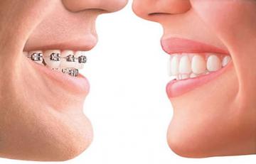 tratament profilaxie, preturi profilaxie dentara Bucuresti