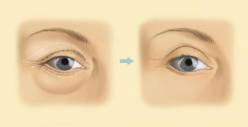 operatie ridicare pleoape, operatie estetica pleoape preturi