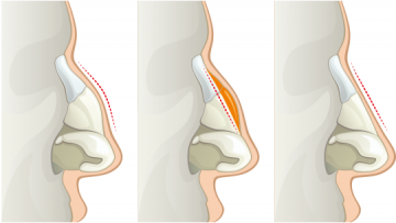 operatie la nas, operatie deviatie de sept, clinica estetica modificare nas, 