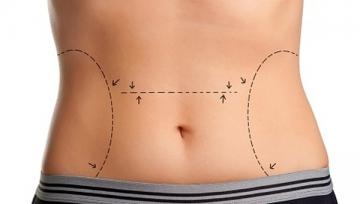 abdominoplastie, pret
