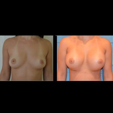 poze, implanturi, silicon, mamare, operatie, implant