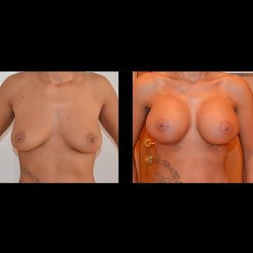 poze, implanturi, silicon, mamare, operatie, implant