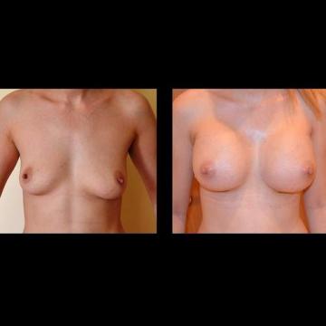 poze, implanturi, silicon, mamare, operatie, implant