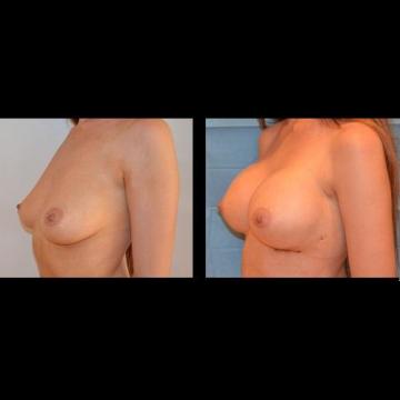 poze, implanturi, silicon, mamare, operatie, implant