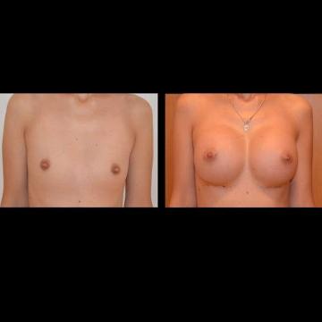 poze, implanturi, silicon, mamare, operatie, implant
