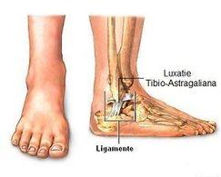 supramax pret catena deformarea artrozei piciorului cum se tratează