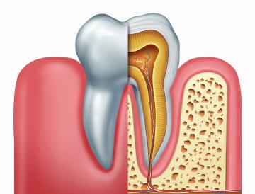 Endodontie microscopica, Endodontie pret, tratarea canalului radicular, tratament de canal