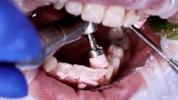 Profilaxie dentara, indepartare placa bacteriana, igiena cavitatii bucale, igienta dentara 